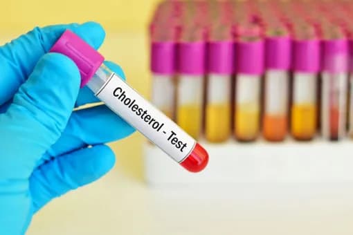 Cholesterol 250 czy to dużo? Poznaj ryzyko i co z tym zrobić